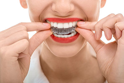 Invisalign-aligners-3